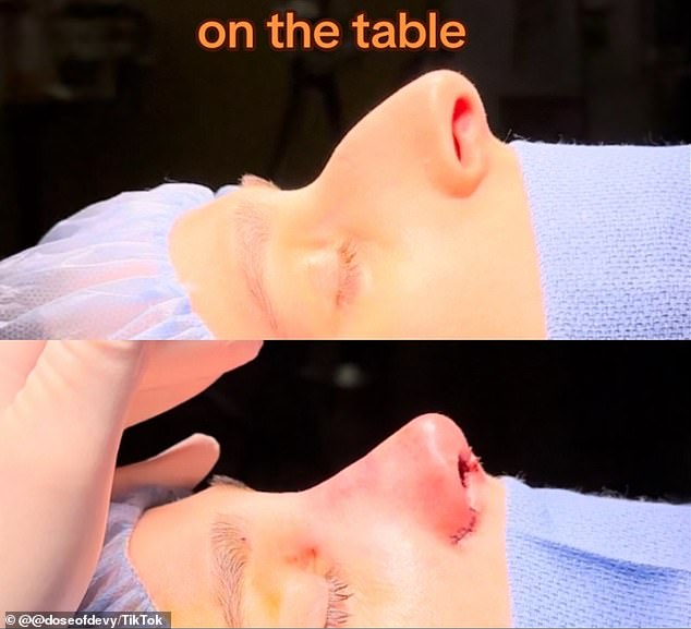 كانت سعيدة بتشاورها مع الدكتورة مارك جينسبرغ ، وهي جراح تجميلية معتمدة من ثلاثة أفراد وإنفادا ، حجزت الإجراء وذهبت تحت السكين في أواخر نوفمبر