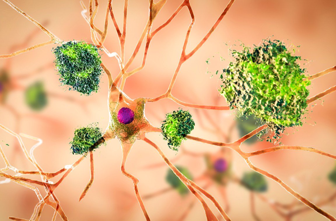 مرض ألزهايمر قد يصيب الإنسان في سن مبكرة.. وهذا الدواء التجريبي قد يساعد