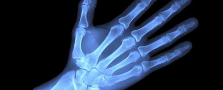 تم العثور على البلاستيكات الدقيقة العميقة داخل العظام البشرية ، يحذر العلماء: Sciencealert 3 تم العثور على البلاستيكات الدقيقة العميقة داخل العظام البشرية ، يحذر العلماء: Sciencealert